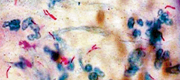 Image: Mycobacterium tuberculosis identified with Ziehl-Nielsen stain (Photo courtesy of the Cleveland Clinic).